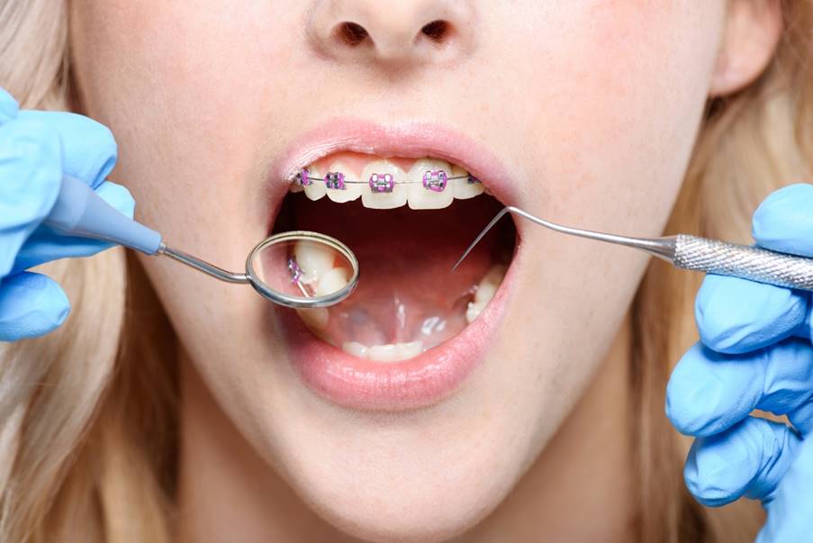 Uncover Good Tactics to Pay for Dental Braces Uncover Good Tactics to Pay for Dental Braces