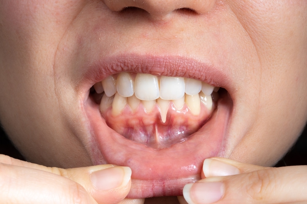 4 Commonplace Preventive Services and products That Offer protection to In opposition to Gum Illness